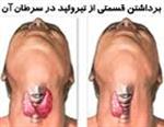 افزایش سرطان تیروئید در ایران