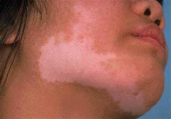آیا لک و پیسهای بوجود آمده در زنان باردار بعد از زایمان برطرف می‌شود یا خیر؟