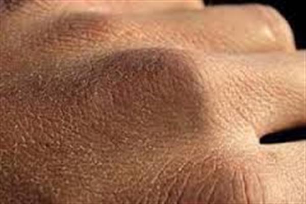 اصول نگهداری پوست در فصل سرما