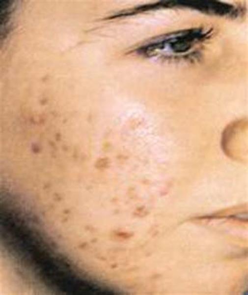 اختلال متابولیسم و رفع جوش‌های قرمز صورت