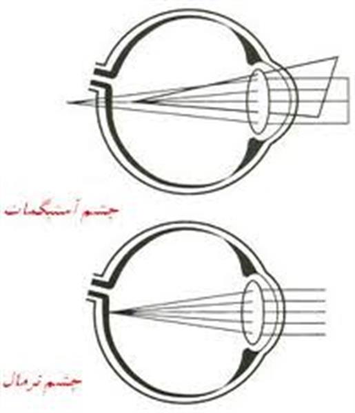 آستیگماتیسم