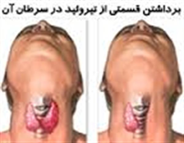 افزایش سرطان تیروئید در ایران